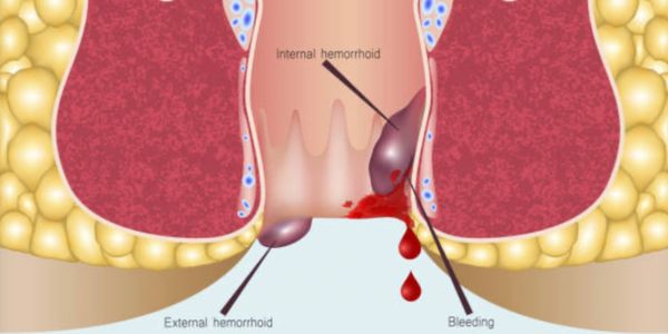 Hemorrhoidal cushions are normal anatomical structure located within the anal canal, usually occupying the left lateral and right anterior and posteri