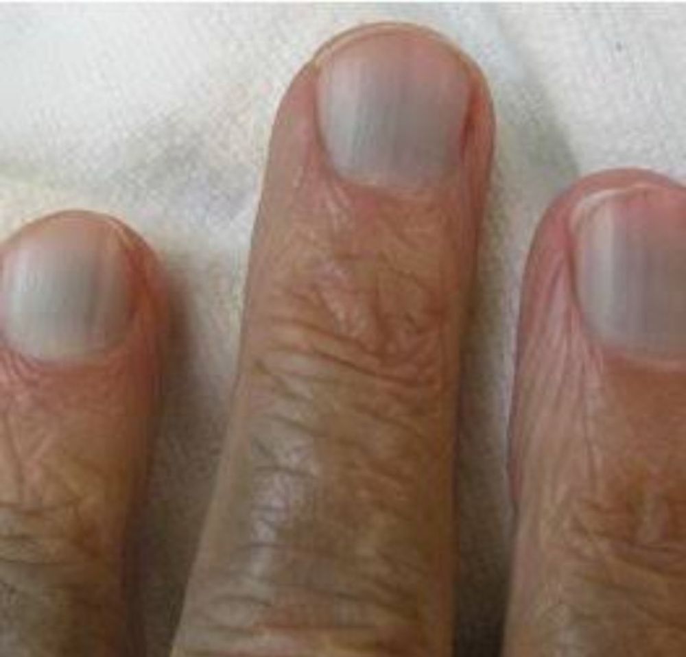 Possible Relation of Skin and Nail Changes in an Infant to COVID-19  Infection | Kalra | International Journal of Clinical Pediatrics